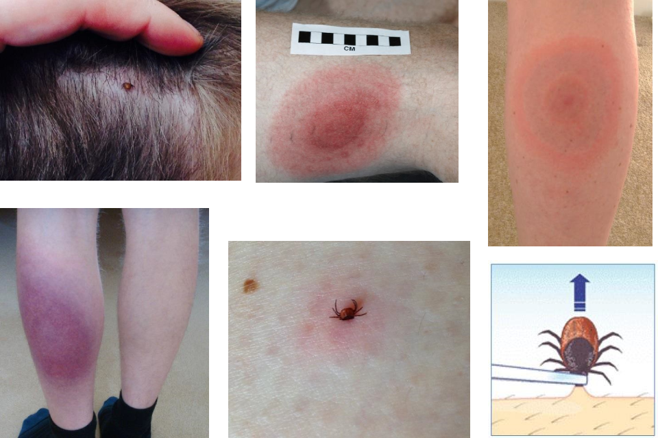 Lyme disease